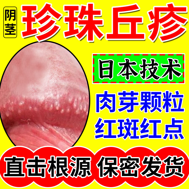 日本龟头珍珠状阴茎丘疹去除冠状沟珍珠粒疹阴茎皮下小水泡疙瘩hv