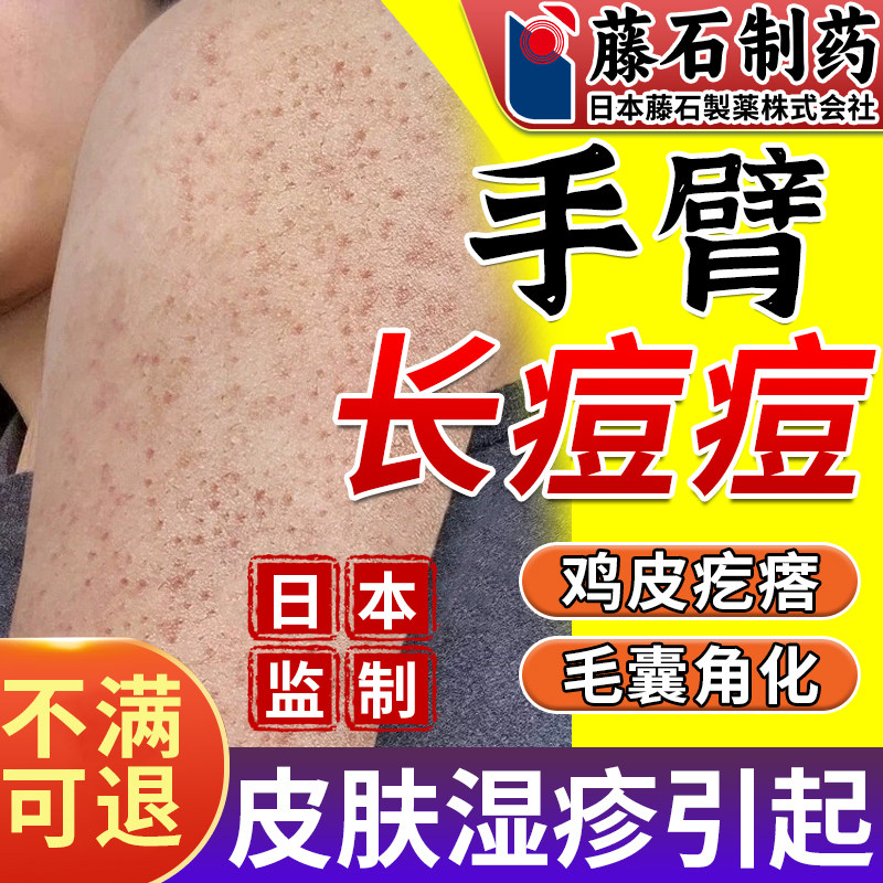 手臂毛囊炎专用喷雾剂胳膊上长小疙瘩小红点鸡皮肤角化药监备案OM