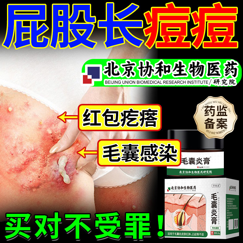 屁股上长痘痘痤疮膏臀部痒起热疙瘩藓火疖子坐疮膏毛囊炎药膏om