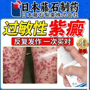 过敏性紫癜疗色素皮下出血红点瘀皮炎血管炎儿童药监备案OM