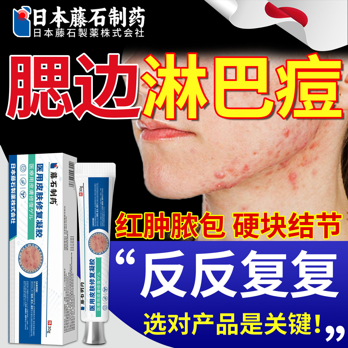 淋巴腮边痘下巴反复长痘痘痤疮脖子毛囊炎下颚线疙瘩硬块软膏OM