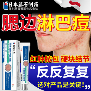淋巴腮边痘下巴反复长痘痘痤疮脖子毛囊炎下颚线疙瘩硬块软膏OM