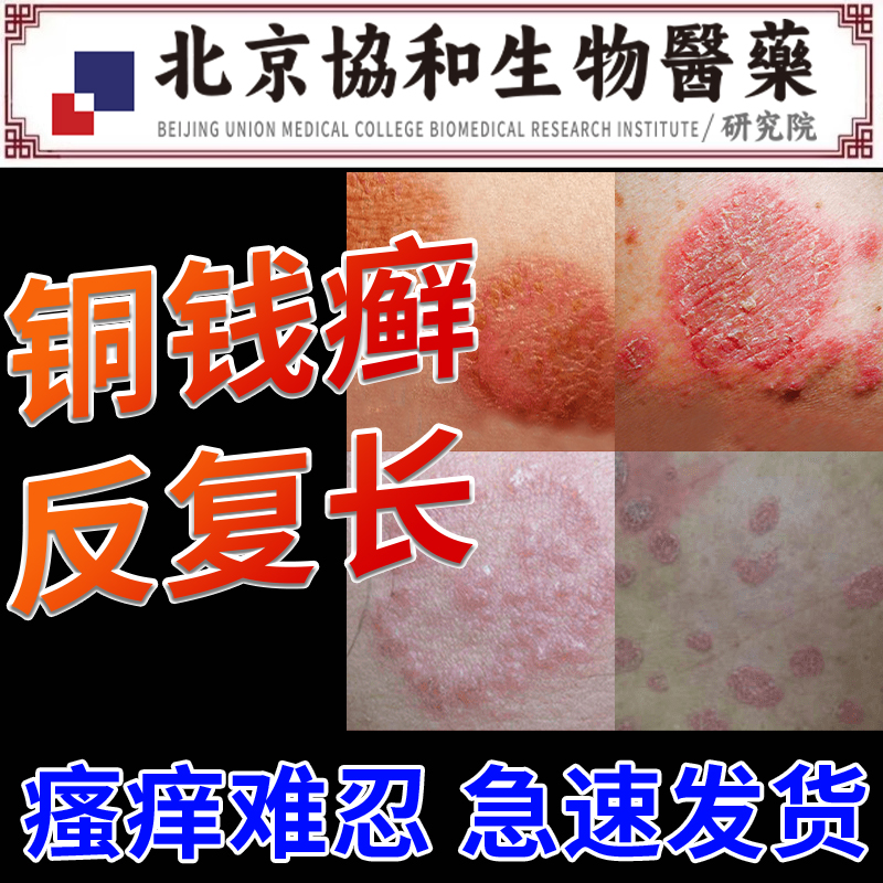 铜钱癣铜钱藓皮肤瘙痒止痒抑菌杀菌专用膏正品可搭配皮癣净药膏zw
