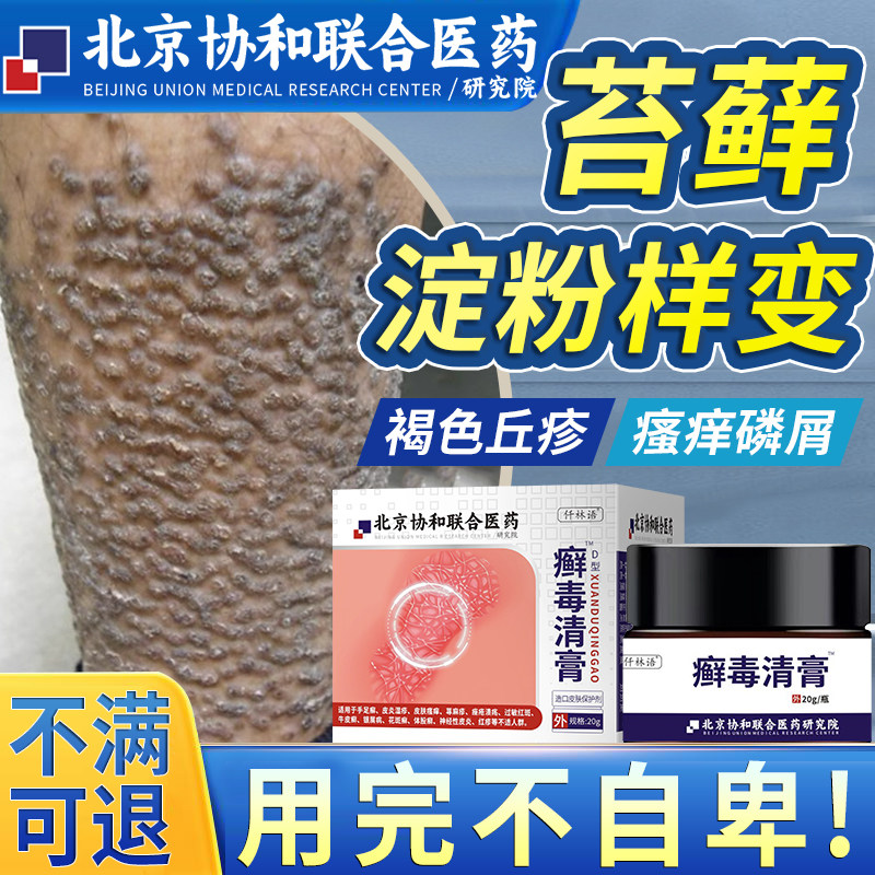 苔藓皮肤淀粉样变专用治疗顽固后背大小腿黑色素皮肤粗糙药膏om