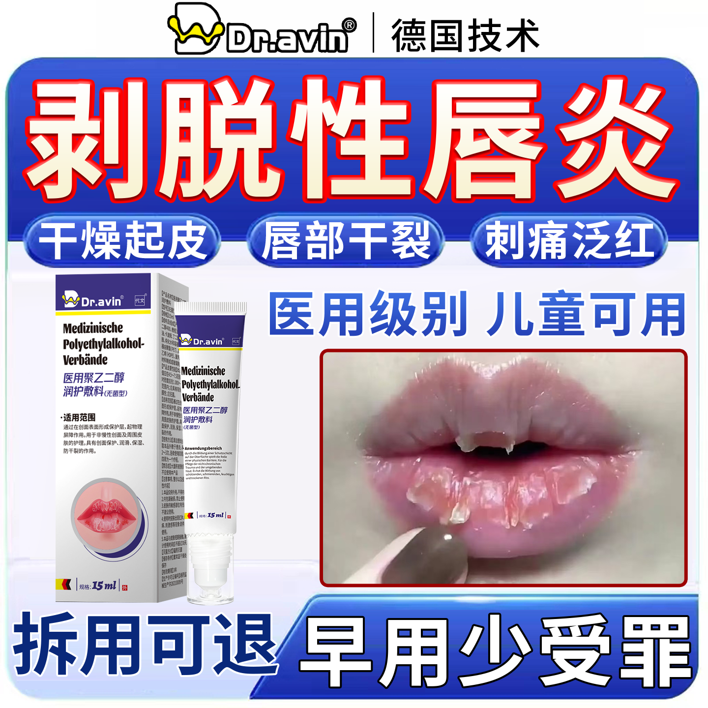 剥脱性唇炎医用级聚乙二醇润护敷料唇膏嘴唇儿童可用防干裂脱皮FJ,医疗器械,医用乳膏（器械）,淘宝优惠券,粉丝福利购,淘宝优惠卷