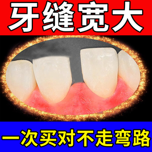 牙缝宽大修复神填充门牙缝龈萎缩修复专用可搭牙膏神器吃饭塞牙OM
