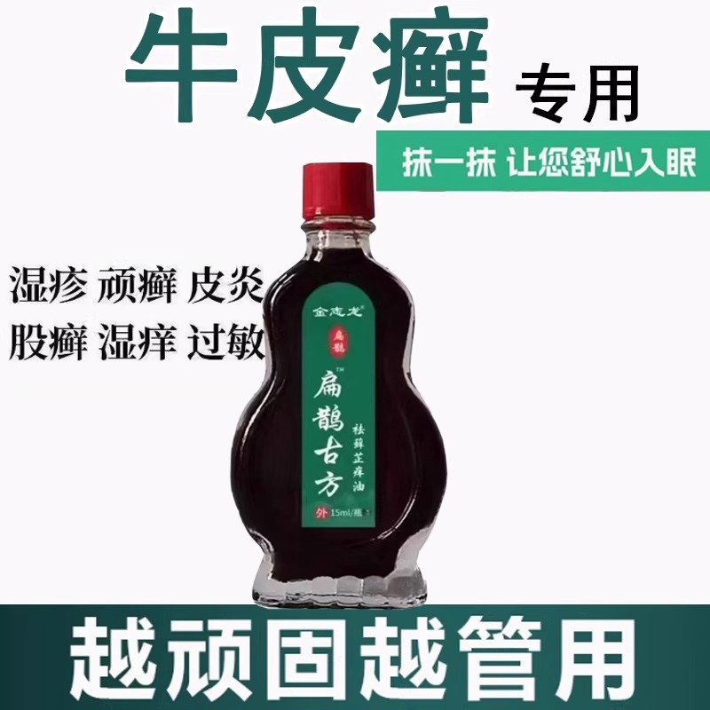 重度牛皮癣止痒油银屑特效油