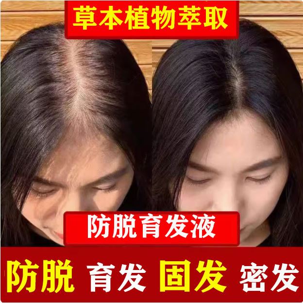 育发液增发液防脱育发液增长发密发修复头皮毛囊何首乌防脱精华液