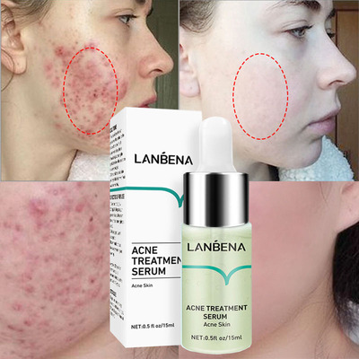 极速Effective Acne Removal Serum Salicylic Acid AntWi-Acne F