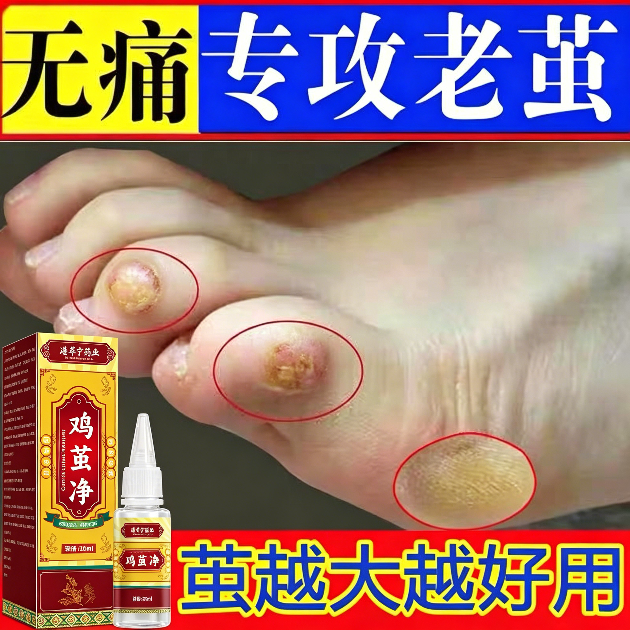 老茧祛除剂无痛软化手足死皮液