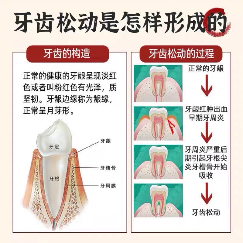 极速【重度牙f龈萎缩】牙齿松动牙膏牙晃动修复牙龈肿痛酸软出血S