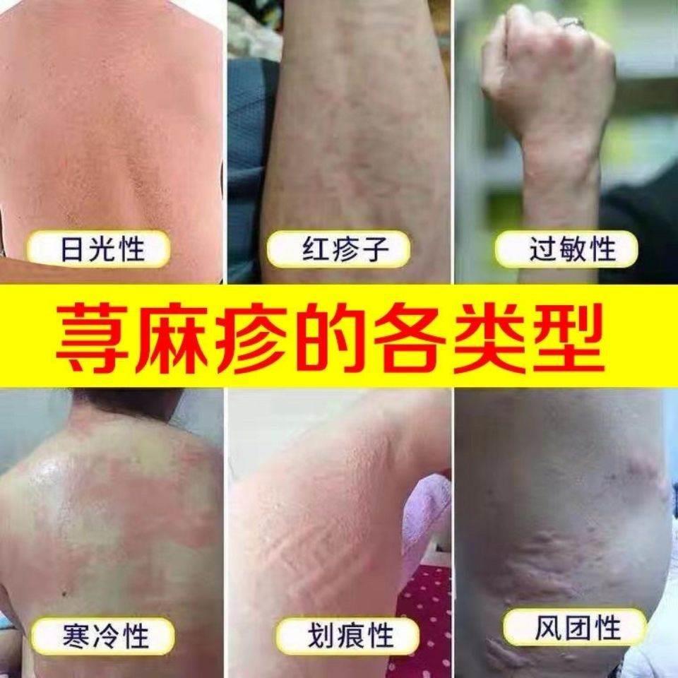 好货御笑堂舒肤灵麻疹团风DWK疹块风荨丘疹急慢皮肤瘙红疹痒子草