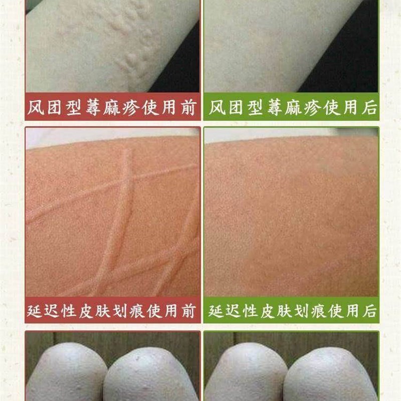 好货荨麻脱疹敏膏各类型寻麻诊过敏皮肤膏肤病膏.