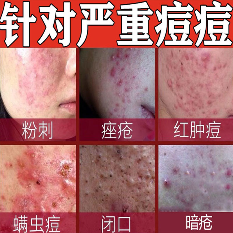 网红去淋巴痘腮边痘下巴青春痘腮帮子脸颊两边脖子长痘根祛重度暗