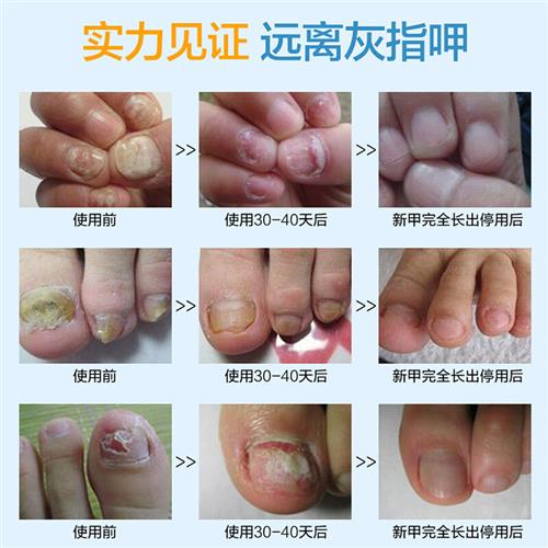 极速芊茗草初妮甲酶解凝胶修复去C除厚灰指甲套组恢复亮甲送指甲