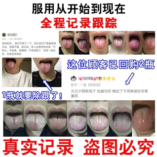 灼口症灼口综合症舌头发热发麻疼痛裂纹舌头发炎烧辣灼痛感专用