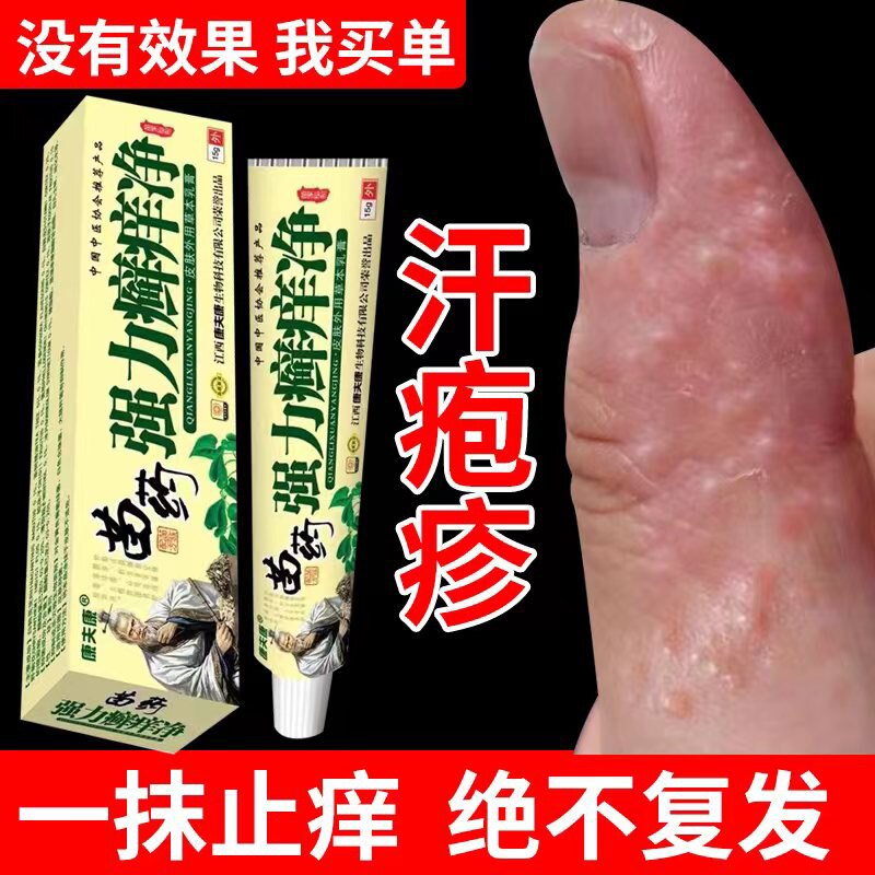 速发手状疱疹疱上皮肤瘙痒起小水泡止痒脱皮汗泡汗疹专用软膏药膏