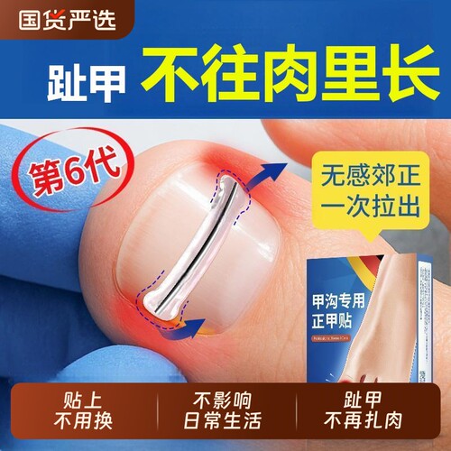 【3天显效】甲沟矫正器