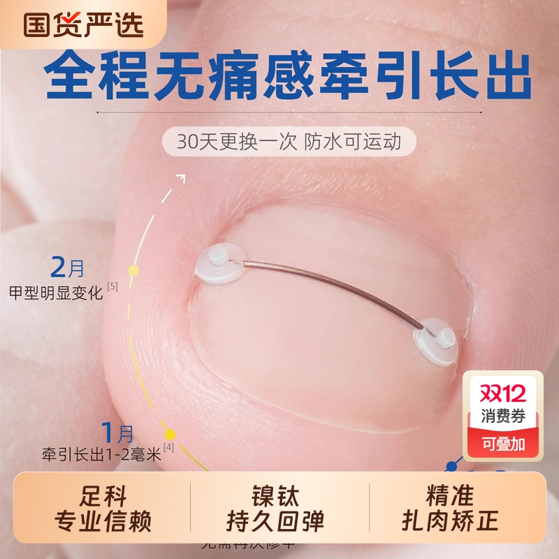 脚趾甲沟嵌甲矫正器合金牵引弹丝正甲器正甲贴片炎脚指甲扎肉神器
