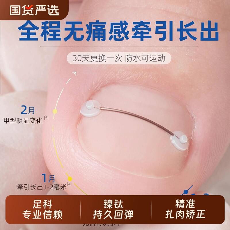脚趾甲沟嵌甲矫正器合金牵引弹丝正甲器正甲贴片炎脚指甲扎肉神器