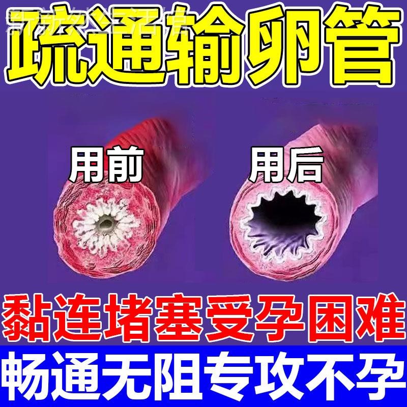 治疗输卵--管堵塞疏通的药宫盆腔积水积液粘连而不畅热敷包促孕贴