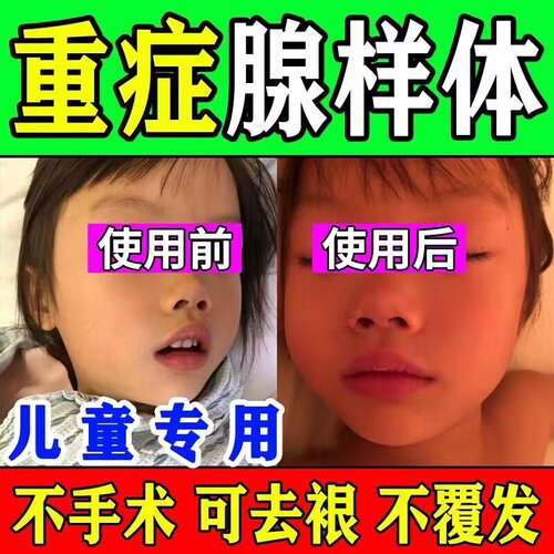 极速【快速矫正】儿童防张嘴巴呼吸神器 闭嘴封嘴贴腺Z样体面容矫