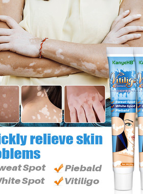 极速10pcs Herbal Extract Vitiyligo Ointment Remove Ringworm
