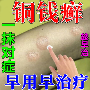 曲安奈德益康唑乳膏铜钱癣体癣皮肤瘙痒越挠越痒专用抑菌药膏