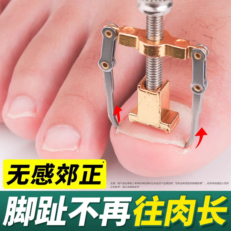 甲沟嵌甲矫正神器睡一觉改善