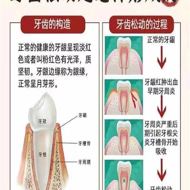 速发【重度牙齿肿动】膏晃动牙龈松痛萎缩出血牙根外露专用固齿牙