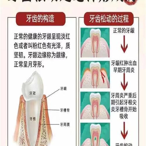 速发【重度牙齿肿动】膏晃动牙龈松痛萎缩出血牙根外露专用固齿牙