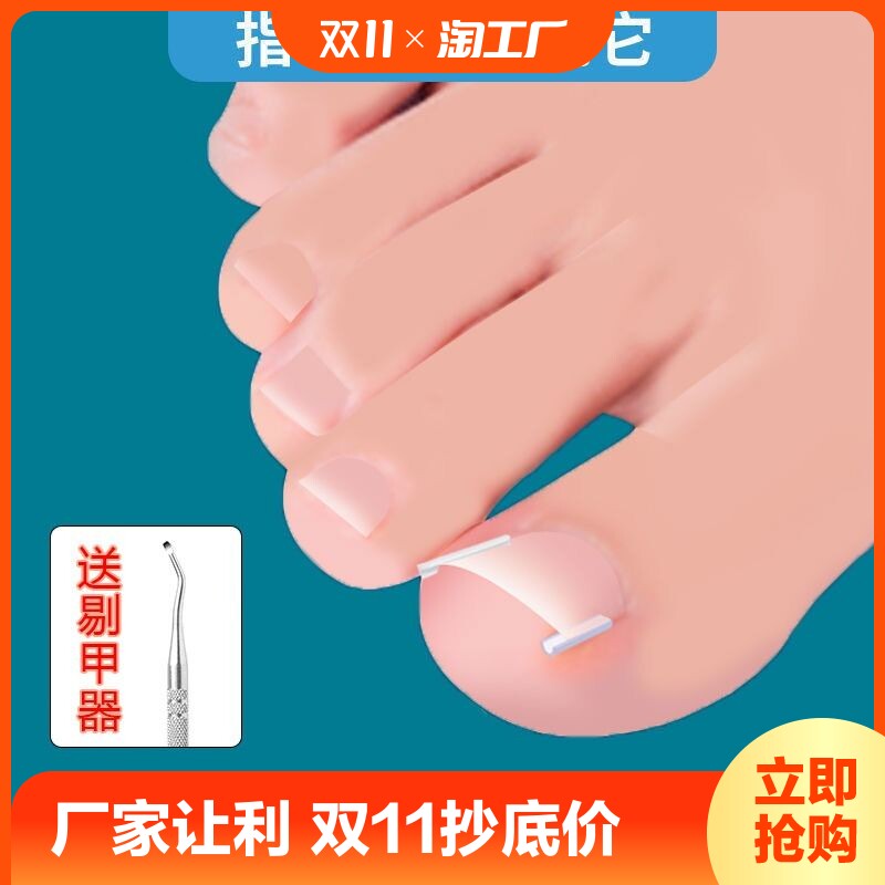 速发甲嵌矫正器沟纠矫正器脚趾甲卷指甲甲正正甲扣拉拉炎正甲贴片