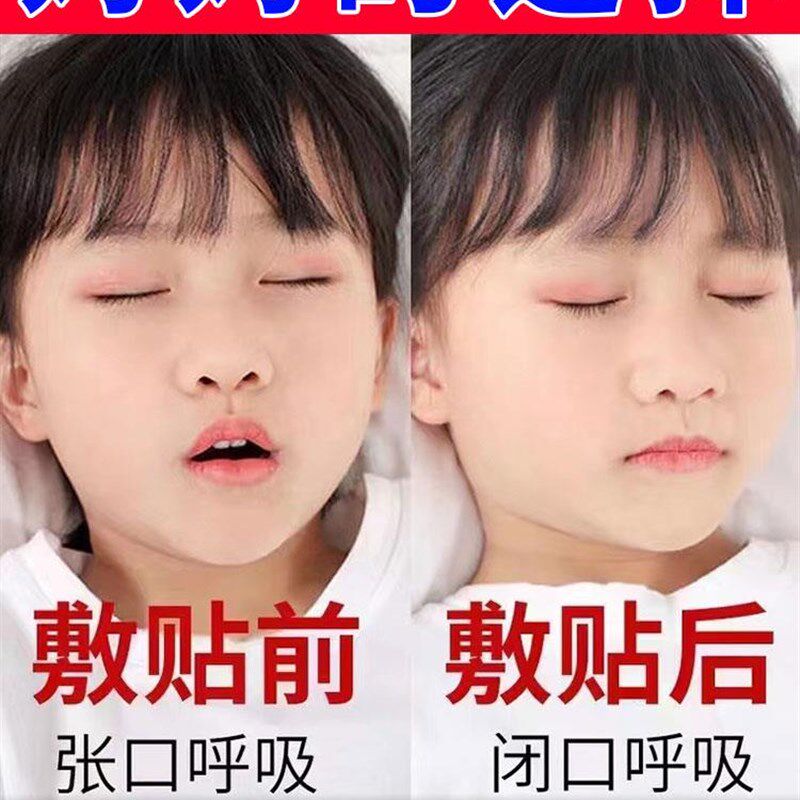 速发腺药体肥大面容正矫器中样贴儿童宝宝张嘴呼吸睡觉不通气专用