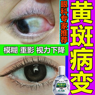 极速去除眼白黄斑病变眼水眼白清澈G去黄眼睛混浊干涩发痒滴眼液