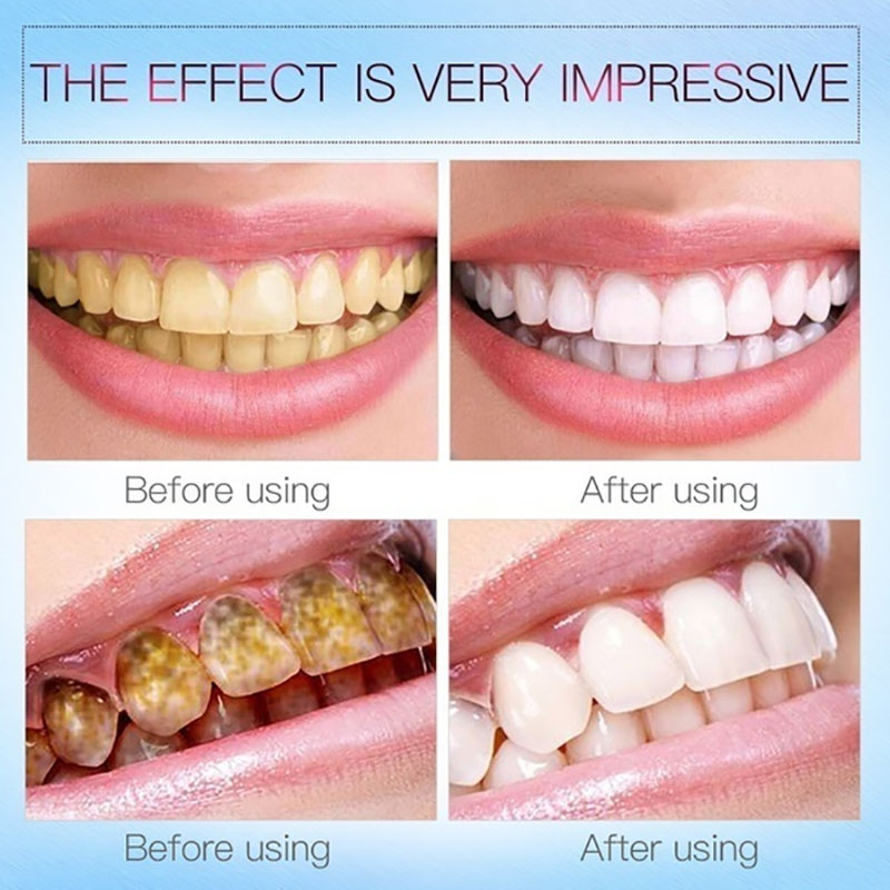 极速MeiYanQiong Teeth Whitening Pen Remove PlaRque And Tarta