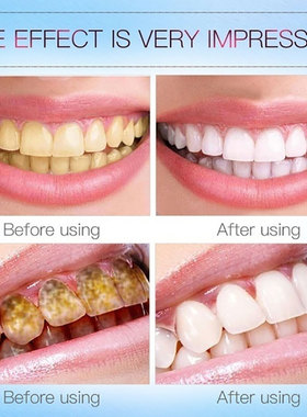 极速MeiYanQiong Teeth Whitening Pen Remove PlaRque And Tarta