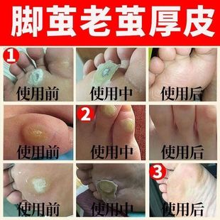 极速去脚老茧死皮软化剂脚底去除A手上老茧硬皮脚茧脚趾头关节茧