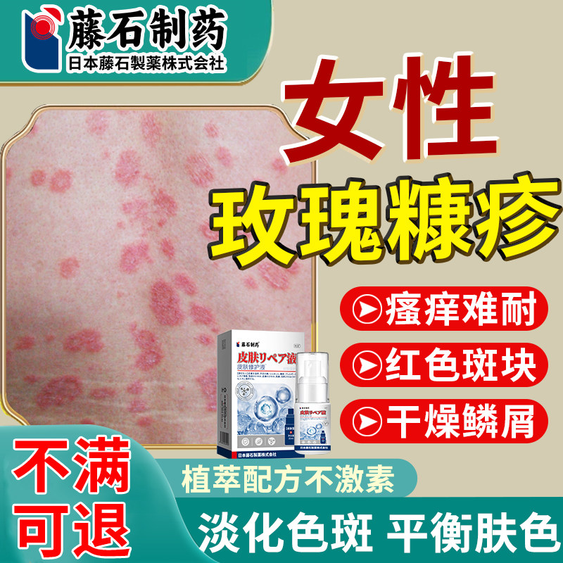 玫瑰糠疹专止痒用药根身体乳除膏贴治疗皮肤癣瘙痒红斑皮炎喷雾xu