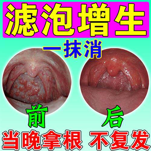 极速舌根淋巴滤泡增生咽後壁喉y咙异物感有痰扁桃体发炎咽喉肿痛