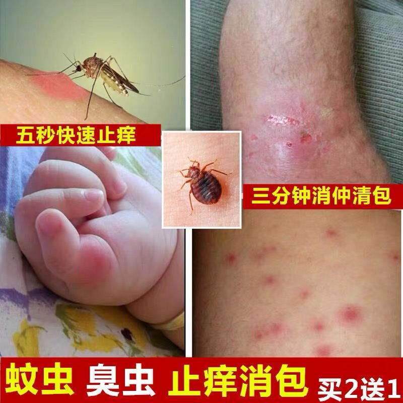 现货速发跳蚤臭虫蚊虫叮咬外用皮肤过敏瘙痒止痒儿童成人药膏;