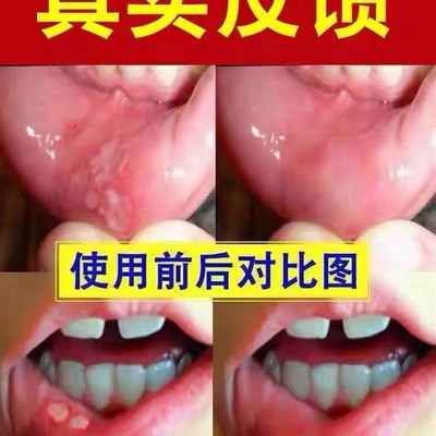 速发【当晚秒见校】口腔溃//疡专用修复喷剂嘴巴起泡上火钻心疼特