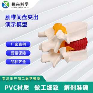 椎间盘模型人体腰椎突出病理演示模型11 7.6CM