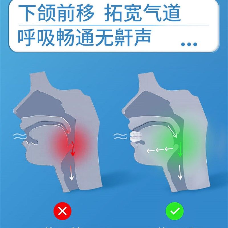 极速止鼾牙套神器阻止打鼾v打呼噜止鼾器呼吸暂停口腔矫治器机防