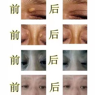 极速眼脸黄瘤【一抹消】去除y睑黄优膏脸部黄斑瘤药眼角上黄斑凸