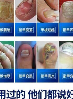 极速脚指甲增厚变黄灰甲神器脚趾甲变厚发黄变硬黄U指甲盖坏甲变