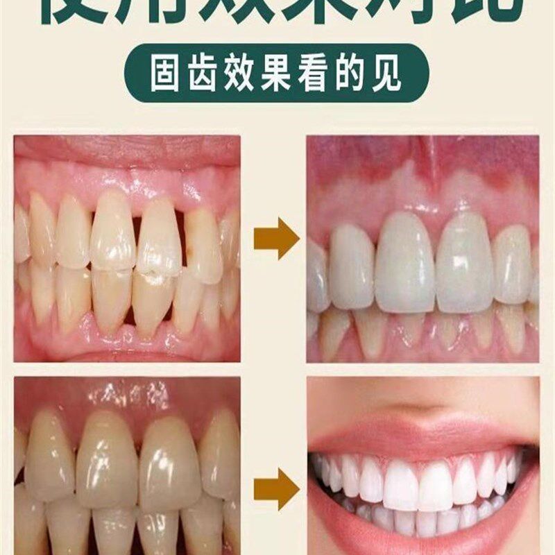 极速【牙松用它】牙齿松动萎缩咀C嚼无力牙膏修护牙龈肿痛出血酸