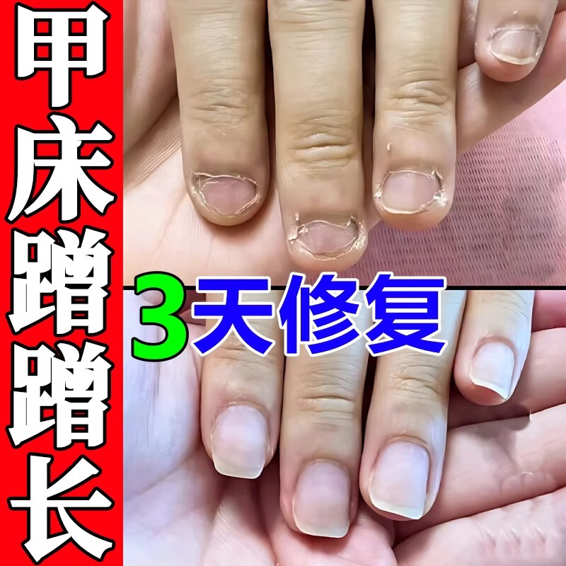 指甲游离线甲床分离空甲修复生长液指甲受损萎缩分离护甲油养甲床