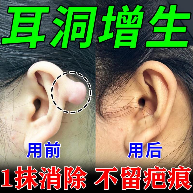 耳洞增生疙瘩凹凸疤痕疙瘩软化修复膏护理液耳朵发炎贴清洁瘢痕膏