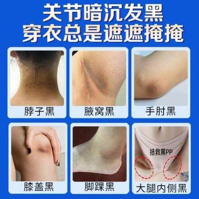 色白愈康愈乳QQM下膏大腿内侧脚踝腚腋关节手肘胳膊肘脖子黑素膏