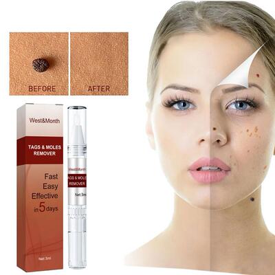 2 Pcs Remover Anti Verruca Remedy iquid Pen Quickly Remove